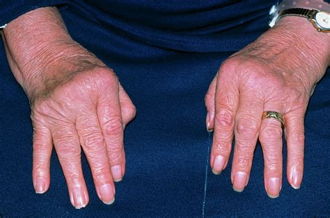 Rheumatoid Arthritis Of Hands With Ulnar Deviation Photograph by Science Photo Library