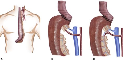 Supercharged cervical anastomosis for esophagectomy and gastric pull-up - The Journal of ...