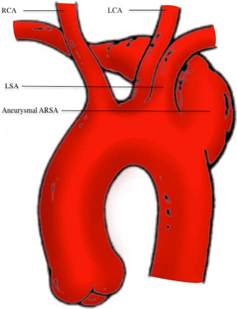 An aberrant right subclavian artery depicted with aneurysmal dilatation ...