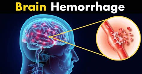 Brain Haemorrhage - Narain Hospital