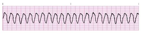 First-Line Treatment for Ventricular Tachycardia? What the Guidelines and Evidence Say - County EM