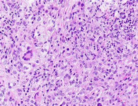 Pathology Outlines - Juvenile xanthogranuloma