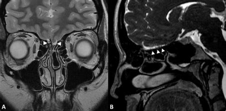 Olfactory Nerve Mri