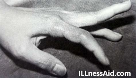 SWAN NECK DEFORMITY: CAUSES, TREATMENT - ILLnessAid