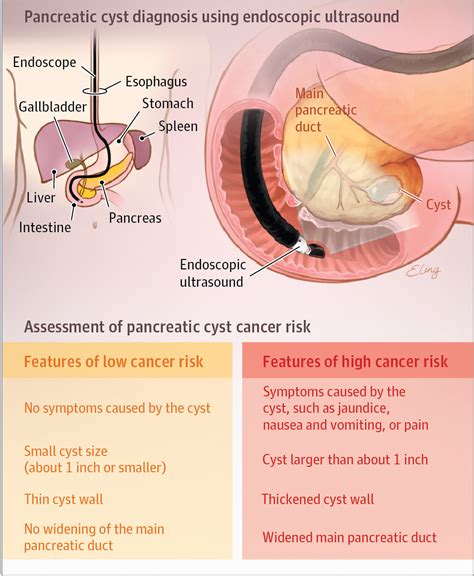 Diagnosis and Treatment of Pancreatic Cystic Neoplasms | Gastroenterology | JAMA | JAMA Network