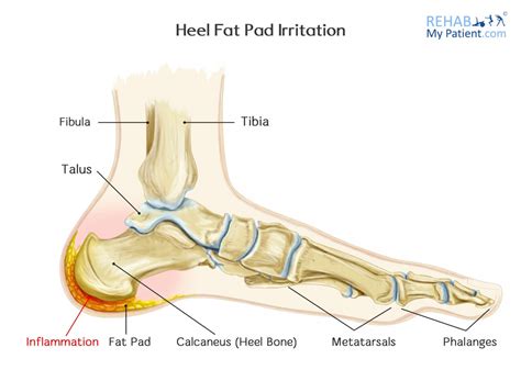 Heel Fat Pad Irritation/Syndrome | Rehab My Patient