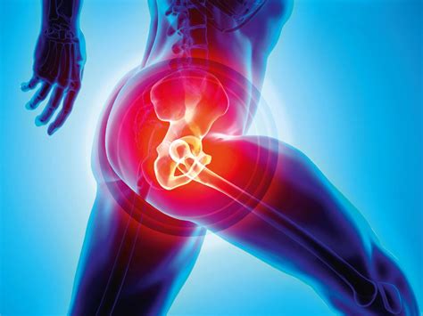 Hip replacement: the pros and cons of early surgery | The Chartered Society of Physiotherapy