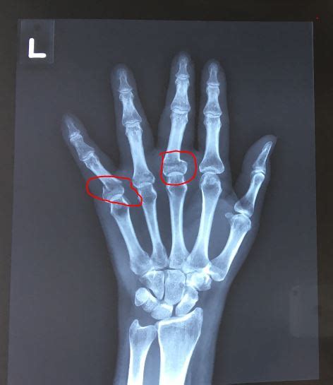 finger fracture – Singapore Orthopaedic & Sports Medicine