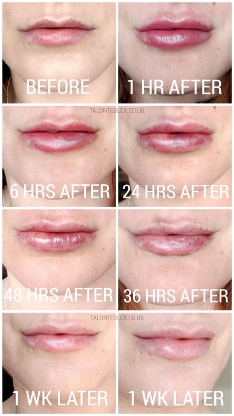 My Lip Fillers Experience with Dr Pamela Benito // Talonted Lex