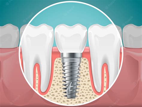 Dental Implant Care: Tips for Maintenance - Royal Dental Clinics Blog