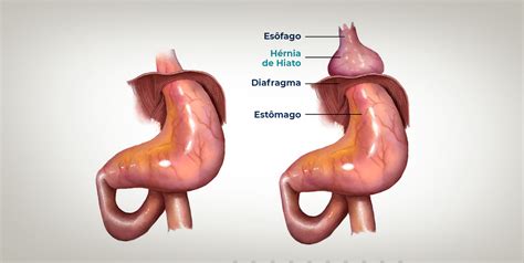 Hérnia de Hiato - Instituto Paulista de Cirurgia