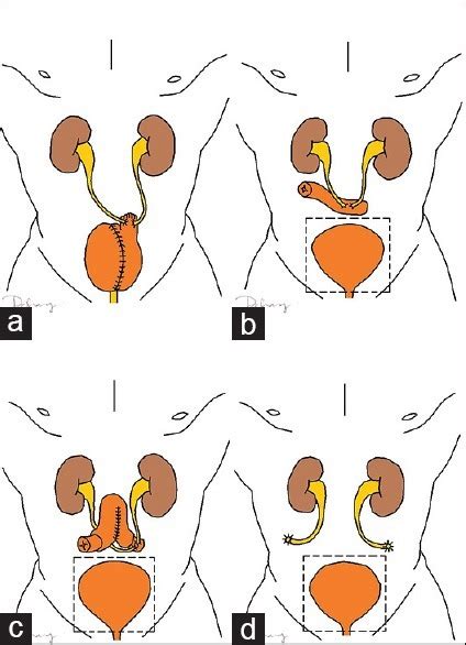 Types of urinary diversion surgery; (a) orthotopic neob | Open-i