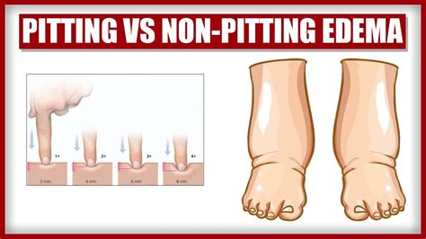 Scale for pitting edema