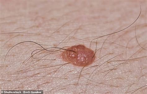 Do moles on our bodies hold the key to curing baldness? | Daily Mail Online