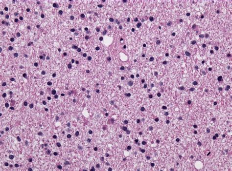 Astrocytoma pathophysiology - wikidoc