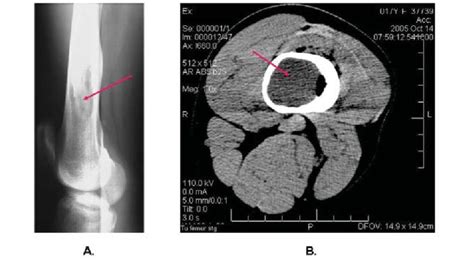 Overt osteitis fibrosa cystica in a patient with type Ib... | Download ...