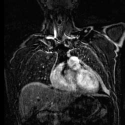 Cardiac MRI - Exeter Heart