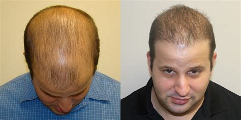 Completely Bald Patient Dramatically Changes His Appearance - Dr. Brett ...