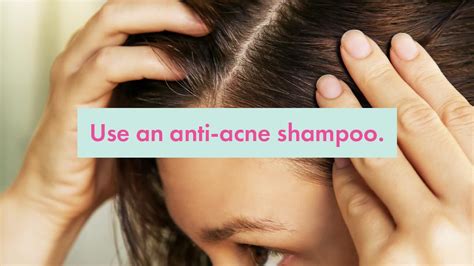 Acne On The Scalp: Causes + Best Treatments