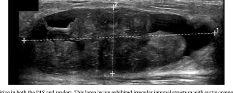 Distinction between phyllodes tumor and fibroadenoma in breast ultrasound using deep learning ...