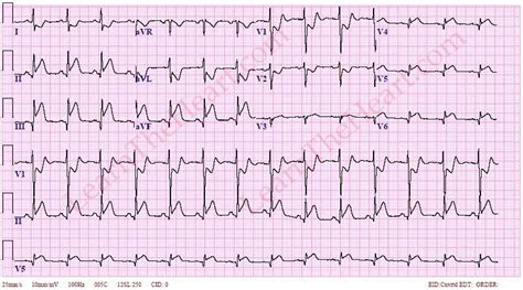 Inferior-Posterior Wall MI ECG 3 | LearnTheHeart.com