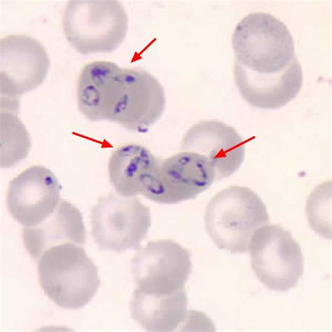 Babesia parasite, babesia infection, symptoms, diagnosis & babesia ...