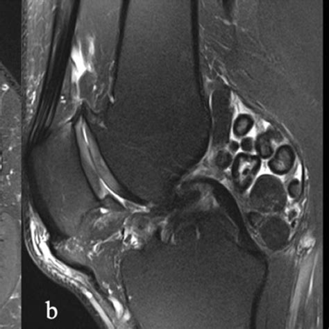 a MRI axial view and b MRI sagittal view. Chondropathy, minimal... | Download Scientific Diagram