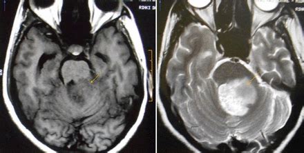 Bruns nystagmus: an important clinical clue for cerebellopontine angle tumours | BMJ Case Reports