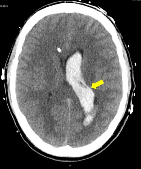 Cureus | Sex, Drugs, and Seizures: Subarachnoid Hemorrhage in a Young Patient