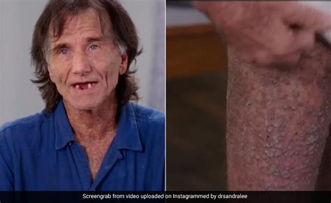 Man With "Crocodile-Like Skin" On His Struggle: "Clothes Hurt So Bad"