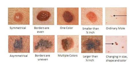 Skin Examinations: A Simple, Lifesaving Procedure for Skin Cancers