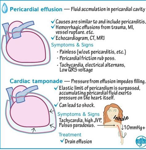 Pathophysiology Of Pericardial Effusion