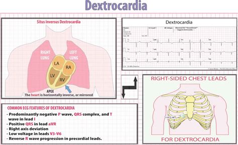 Dextrocardia types, dextrocardia situs inversus, causes, symptoms, ECG & complications