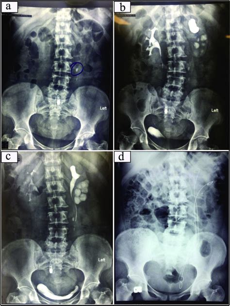 a: KUB x-ray, b and c: IVP, d: Post endoscopic intervention KUB x-ray ...