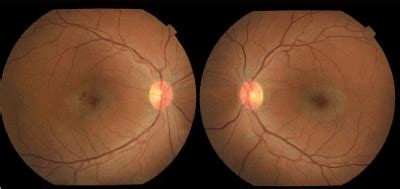 Macular Telangiectasia: A cause of bull’s eye maculopathy