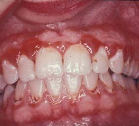 Red swollen gums of gingivitis. | Download Scientific Diagram