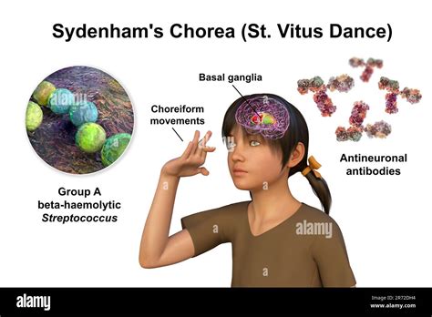 Sydenham's chorea, an autoimmune disease that results from Streptococcus infection, formation of ...