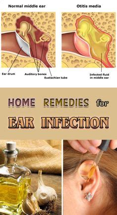 Home Remedies for Ear Infection (With images) | Ear infection remedy ...