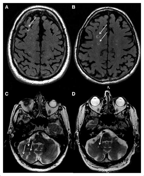 Example images of infarcts in subregions. A, Cortical infarct in the... | Download Scientific ...