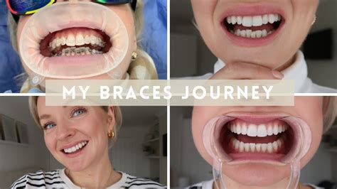 MY ADULT BRACES JOURNEY, TEETH TRANSFORMATION, WEARING FIXED CERAMIC BRACES, WITH BEFORE AND ...