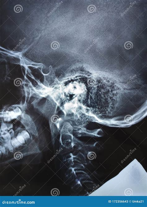 Adenoid Hypertrophy Grade III in Xray Nasopharynx Stock Image - Image ...