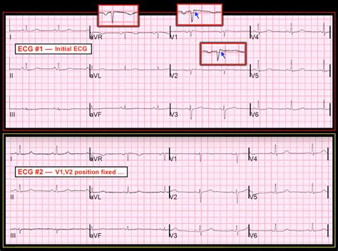 Dr. Smith's ECG Blog: Chest Pain and Q-waves in V1 and V2. Is there ...