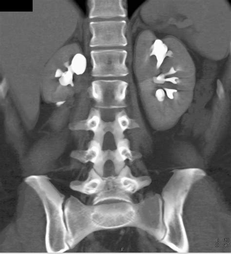 Chronic Pyelonephritis Both Kidneys with Scarring and Calyceal Blunting - Kidney Case Studies ...