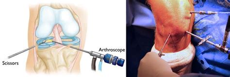 Knee Arthroscopy - OrthoInfo - AAOS