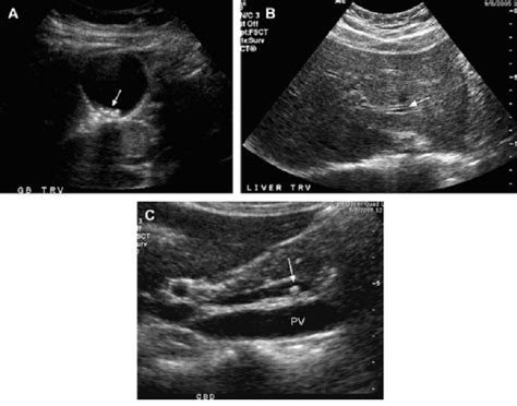 Choledocholithiasis Ultrasound - Radiology Imaging