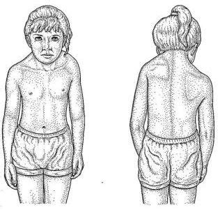 Sprengel Deformity - Congenital High Scapula | Bone and Spine