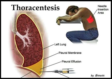 Thoracentesis | The Human Body | Pinterest