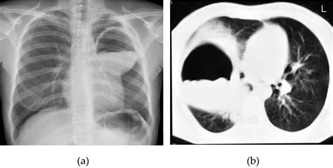 ruptured HC - Water lily or Camelot sign: (a) chest radiography shows a ...