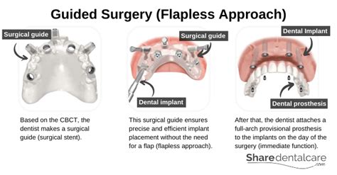 All-on-4 Dental Implants: Smile Back in 1 Day - Share Dental Care