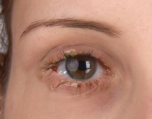 Blepharitis Treatment Orange County | Dry Eyes | Red Eyes Huntington Beach